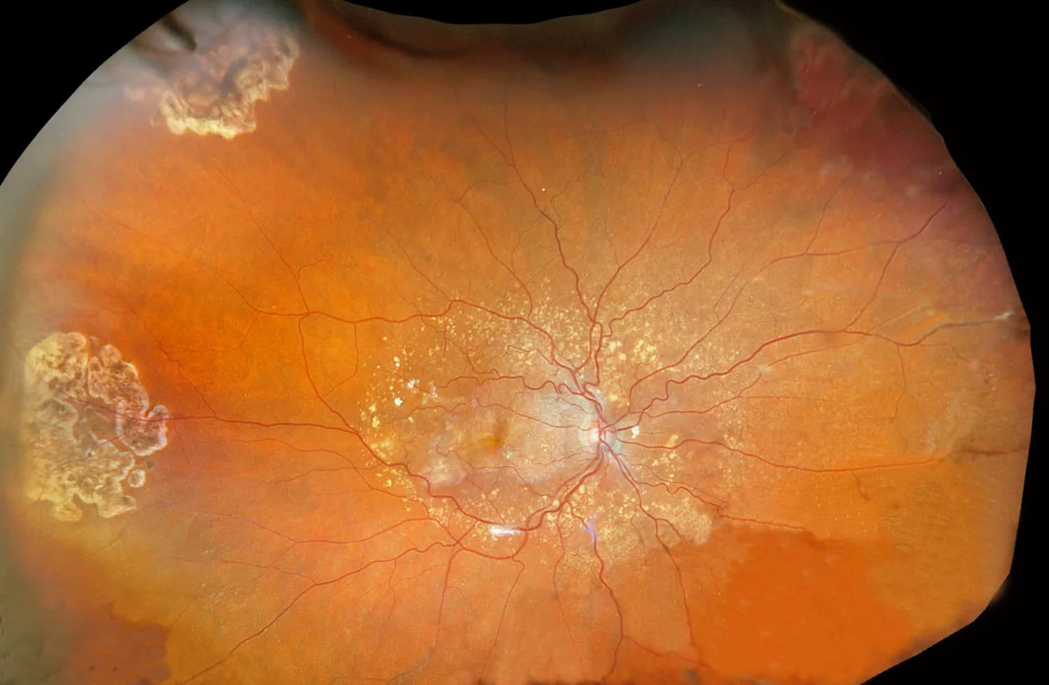 Ultra-widefield optomap color image of the retina, showing the optic nerve and macula at the center with the retinal periphery extending to the edges in a single capture