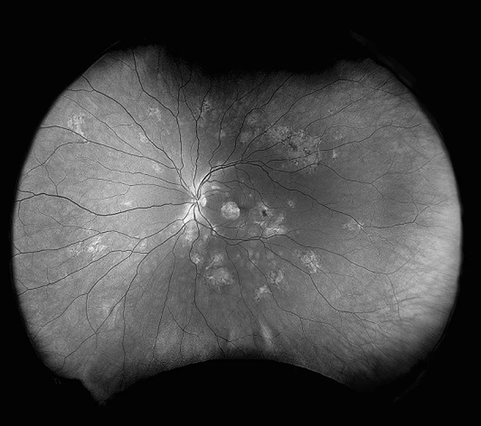 Red-free optomap image of the retina rendered in grayscale, making the retinal blood vessels and subtle surface changes stand out