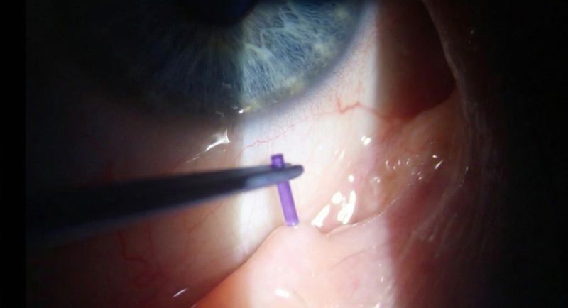 Punctal Involution Punctal Plugs for Dry Eyes: Cost, Types & What to Expect | Newton, MA